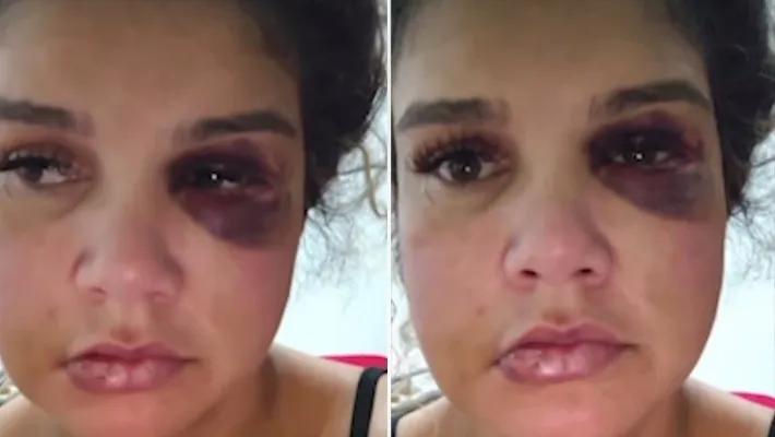 Cantor é acusado de agressão e cárcere privado por esposa que desabafa ao surgir com rosto deformado; veja vídeo